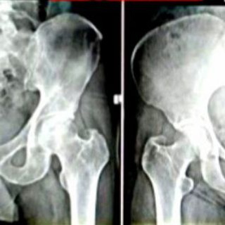 Forensic Anthropology / Tranvestigation